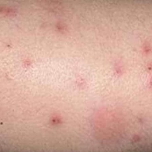 Kem bôi thảo dược ngoài da hỗ trợ Viêm da cơ địa, nấm ngứa, chàm, tổ đỉa,ghẻ nước,hắc lào ,lang ben, vảy nến