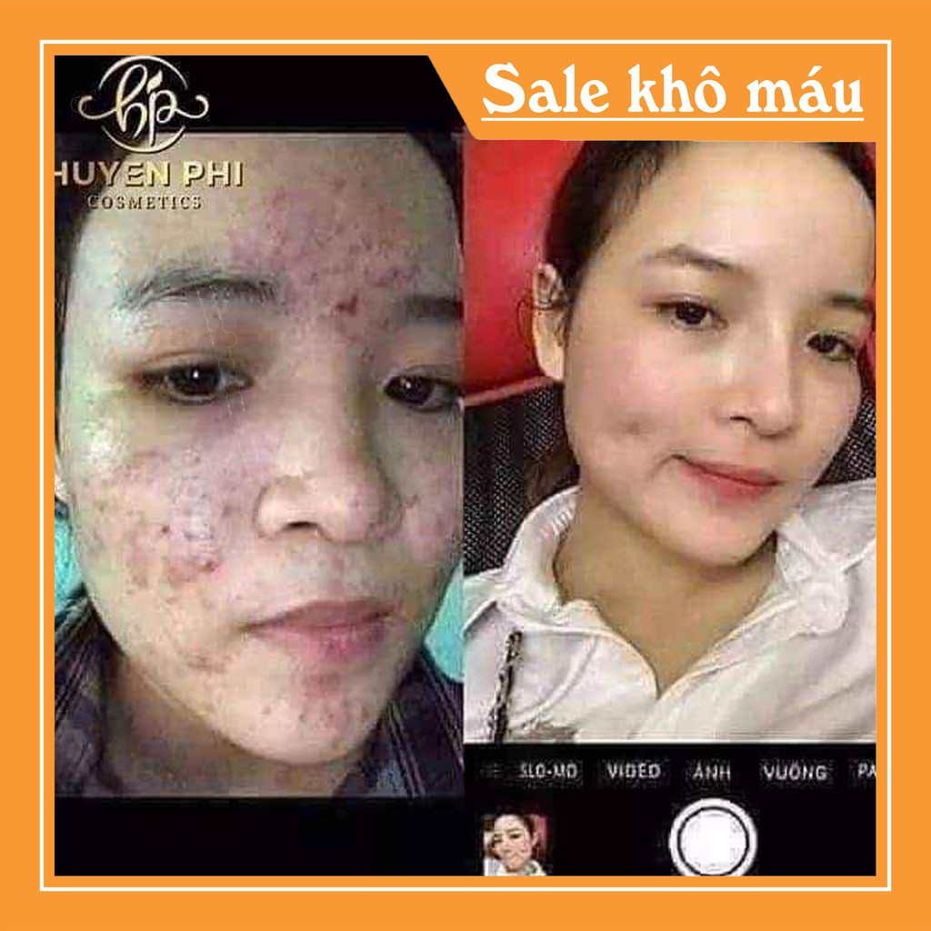 CAO MỤN TẢO NÂU HUYỀN PHI [Hàng Chính Hãng] Cao mụn tảo nâu thảo dược thiên nhiên | BigBuy360 - bigbuy360.vn