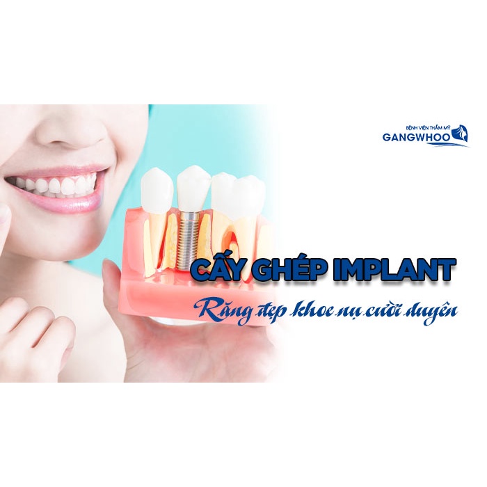 Nha Khoa Cấy Ghép Implant tại Gangwhoo