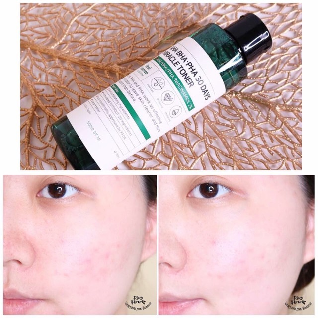 Nước hoa hồng da mụn AHA-BHA-PHA 30 Days Miracle Toner Some By Mi | BigBuy360 - bigbuy360.vn