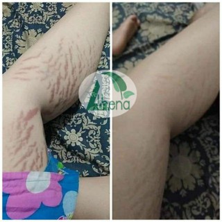 Combo 2 kem multi 18 phòng và làm mờ rạn da cho mẹ bầu hiệu quả cao