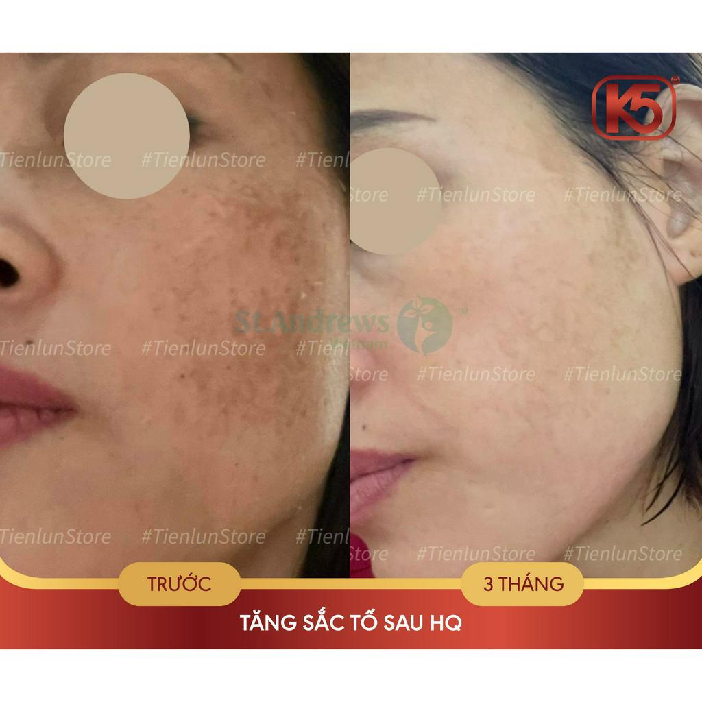 Kem chống tăng sắc tố sau laser K5 Cryolaser 20ml - hiệu quả đã được chứng minh