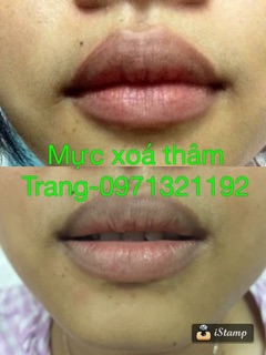 Khử thâm hoàn toàn cho môi