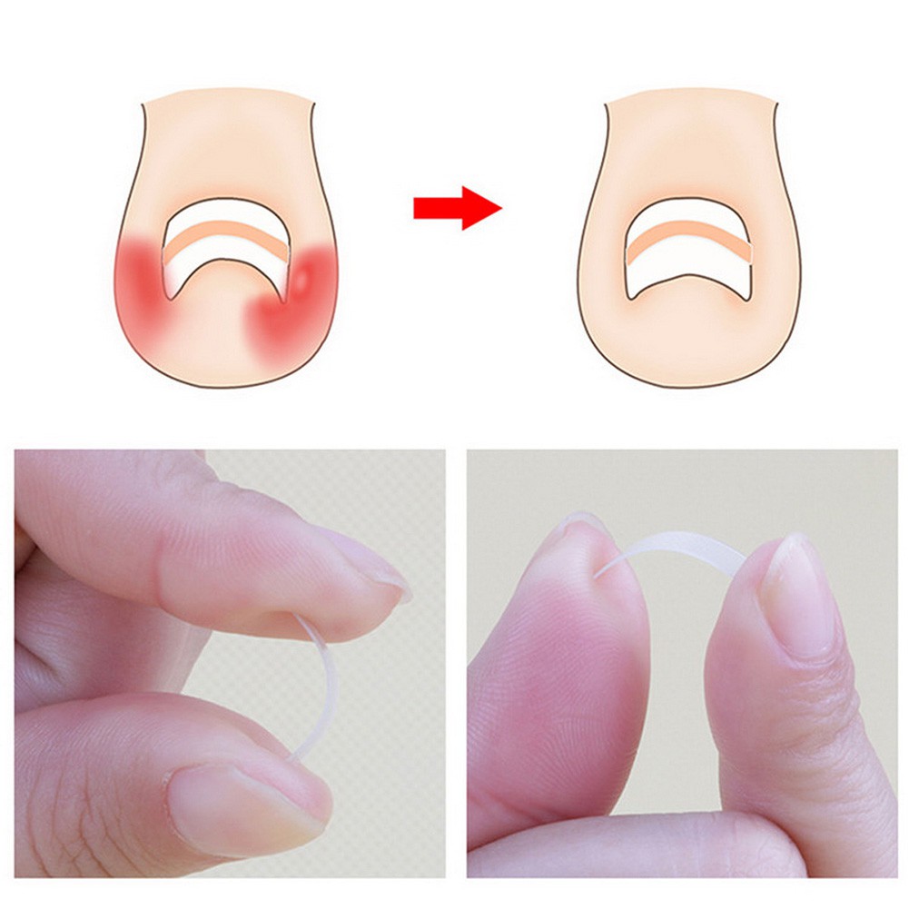 Bộ 10 miếng dán điều chỉnh móng chân mọc ngược 3mm / 3.5mm / 4mm