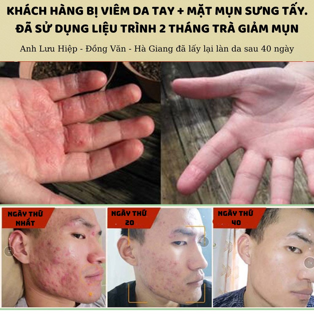 [Da mụn] Trà lá tre Calen Nature's Farm giảm nhờn mờ thâm nám, giúp ngừa mụn hiệu quả qua đường bài tiết bịch 30 gói lọc