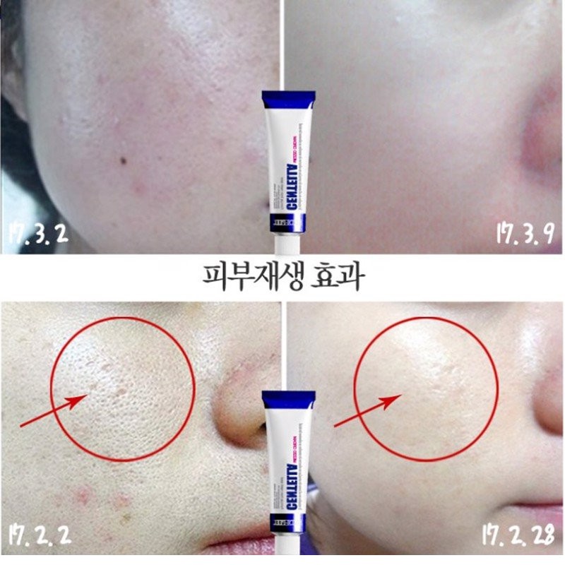 Kem dưỡng ngừa mụn MOON Kem dưỡng rau má Medi-peel Centella Fomula Mezzo Cream 30ml phục hồi làm dịu da mụn cấp tốc