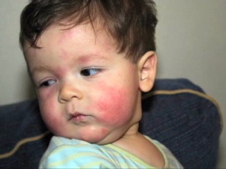 Vỏ Núc Nác Tắm Cho Bé