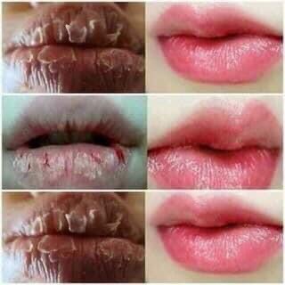 DƯỠNG MÔI EDALLY