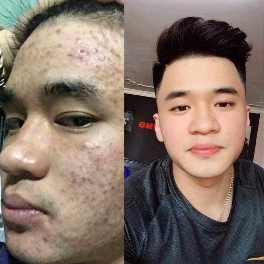 Tạm biệt da thô sần sùi chỉ với kem 3Day colagen