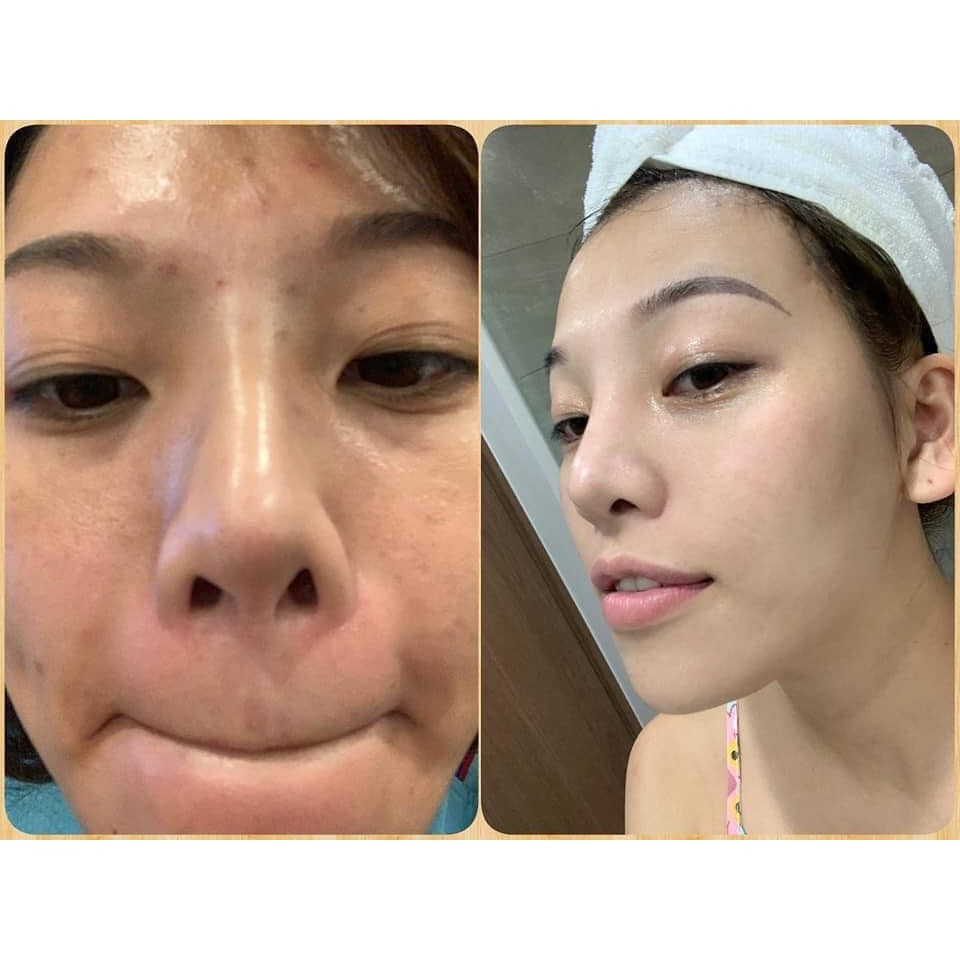 Tinh chất se lỗ chân lông PORE TREATMENT