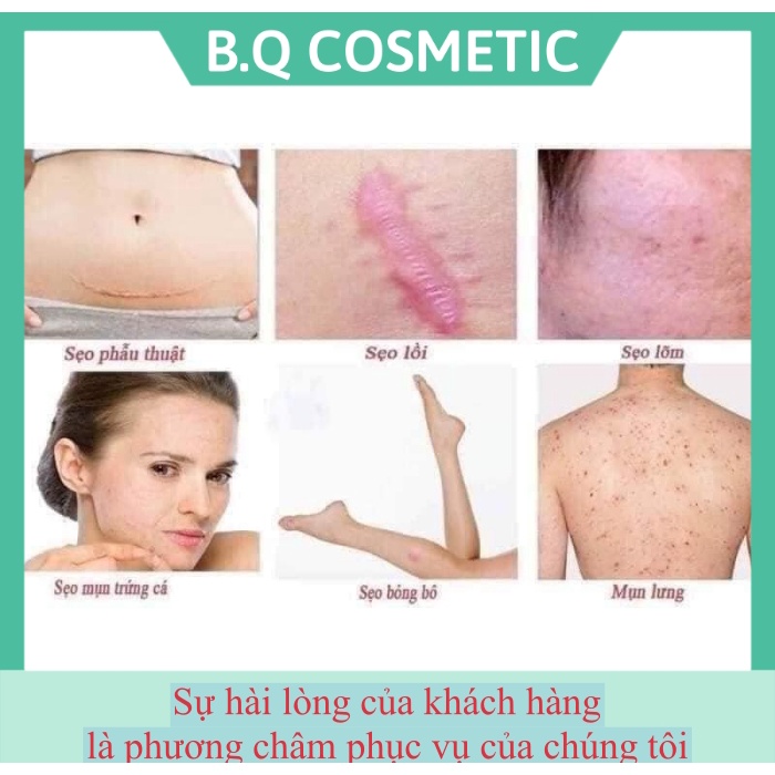 Kem sẹo Hàn Quốc Noscarna