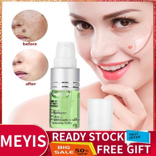 ✨Kem Hỗ trợ giảm tàn nhang Và Đốm Đen Không Đau Hiệu Quả
