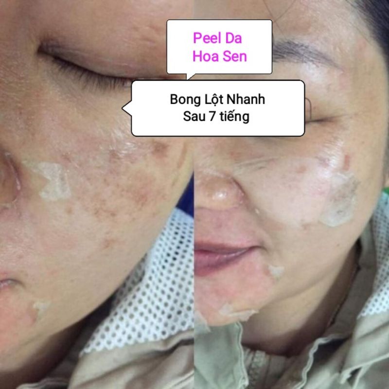 Peel Tái Tạo Trắng Da Hết Nám Lột Nhanh Sau 7 Tiếng