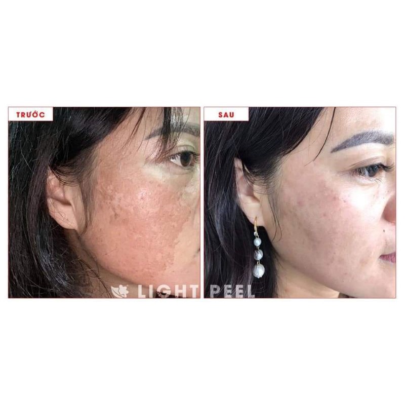 Light Peel X10 Linh Hương Chính Hãng - lăn kim, phi kim tại nhà