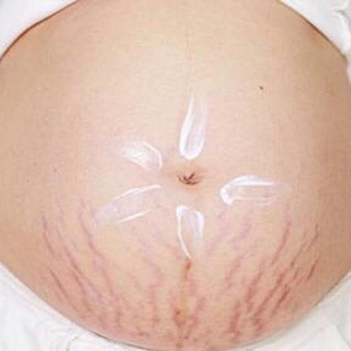 kem trị rạn bụng , đùi OHO Thái lan