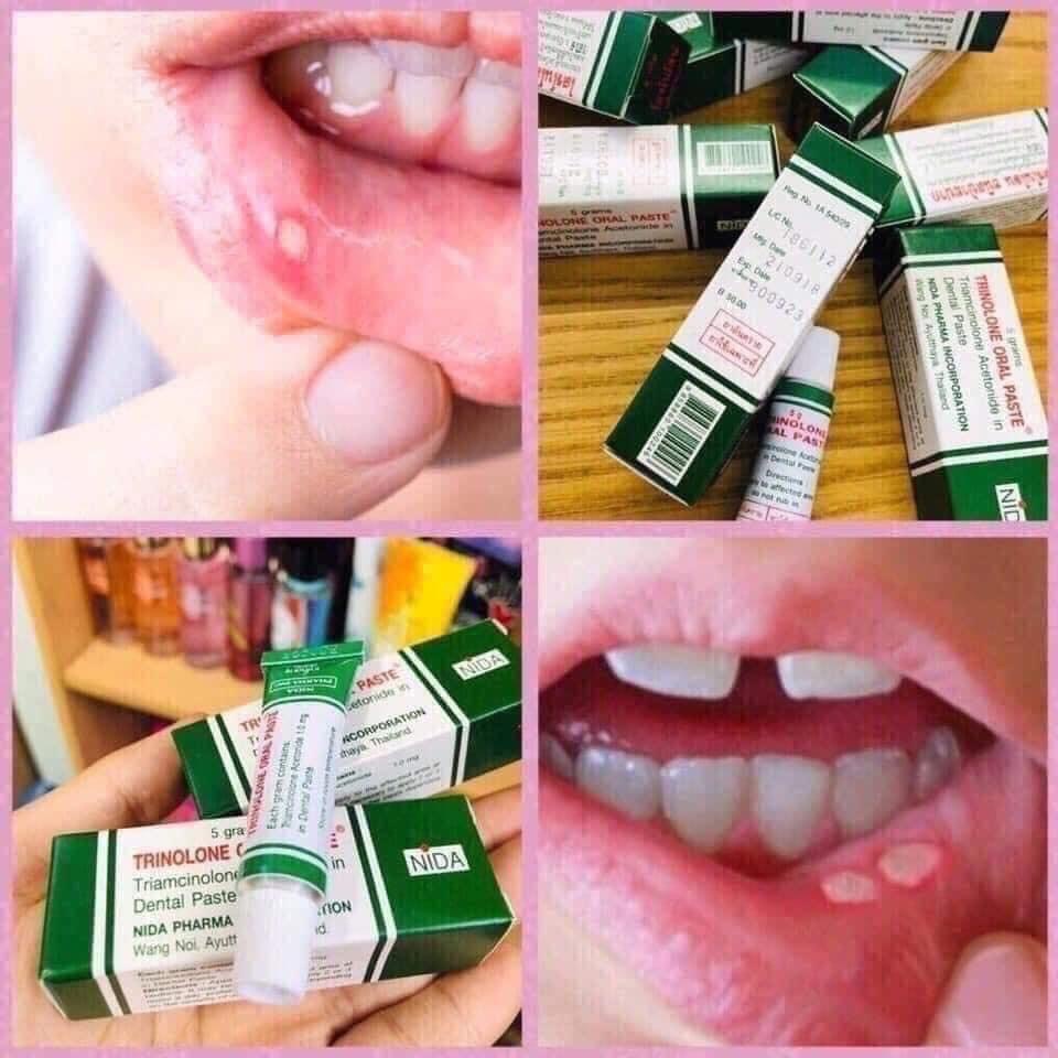Kem Bôi NHiệt Miệng Thái Lan Dùng Cho Cả Người Lớn và Trẻ Nhỏ