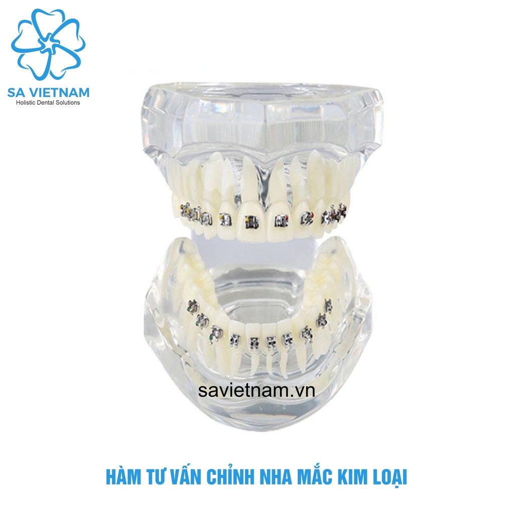 Mẫu hàm tư vấn chỉnh nha mắc cài kim loại – mô hình nắn chỉnh răng nha khoa