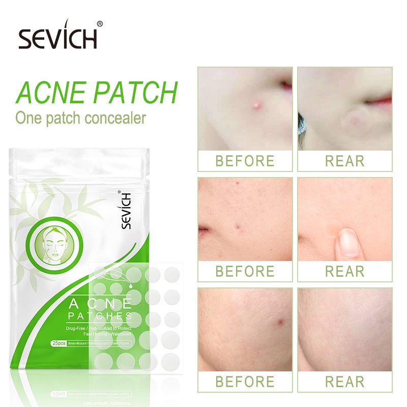 Set 25 miếng dán mụn Sevich tinh chất tràm trà cải thiện mụn hiệu quả | BigBuy360 - bigbuy360.vn