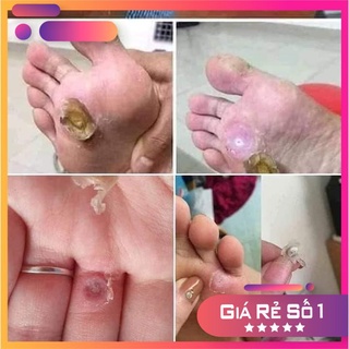 Gel xóa Nốt Ruồi, Mụn Cơm, Mụn Cóc, Mụn Thịt, Tẩy Nốt Ruồi DVELINIL Nga, Cam Kết 100% Chính Hãng