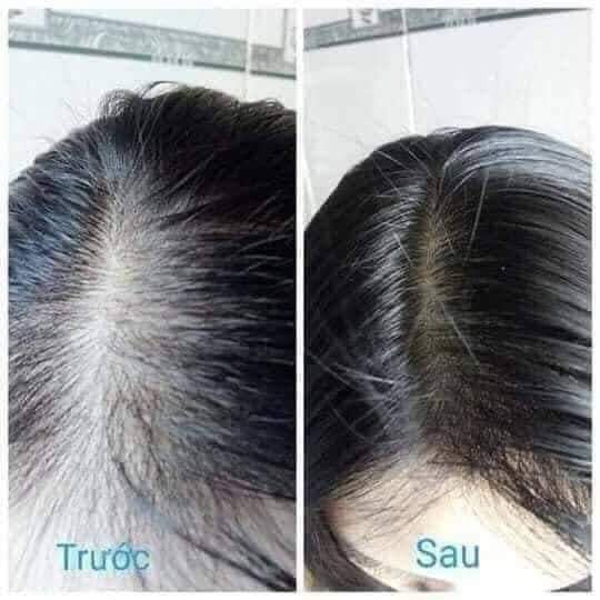 Kích Thích Mọc Tóc Nhanh với Huyết Thanh Serum Mọc Tóc Weilaiya, Cam Kết Hiệu Quả Sau 12 Tuần. Dùng Thử Combo 3 Lọ