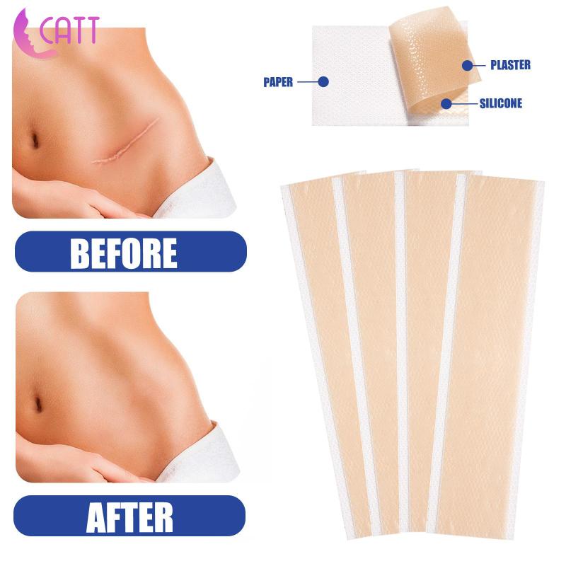 [Dadada1] 4 Miếng Dán Silicone Hỗ trợ giảm sẹo Cho Cơ Thể