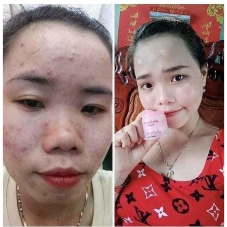 Bộ kem nám Collagen Plus Vit E thai lan