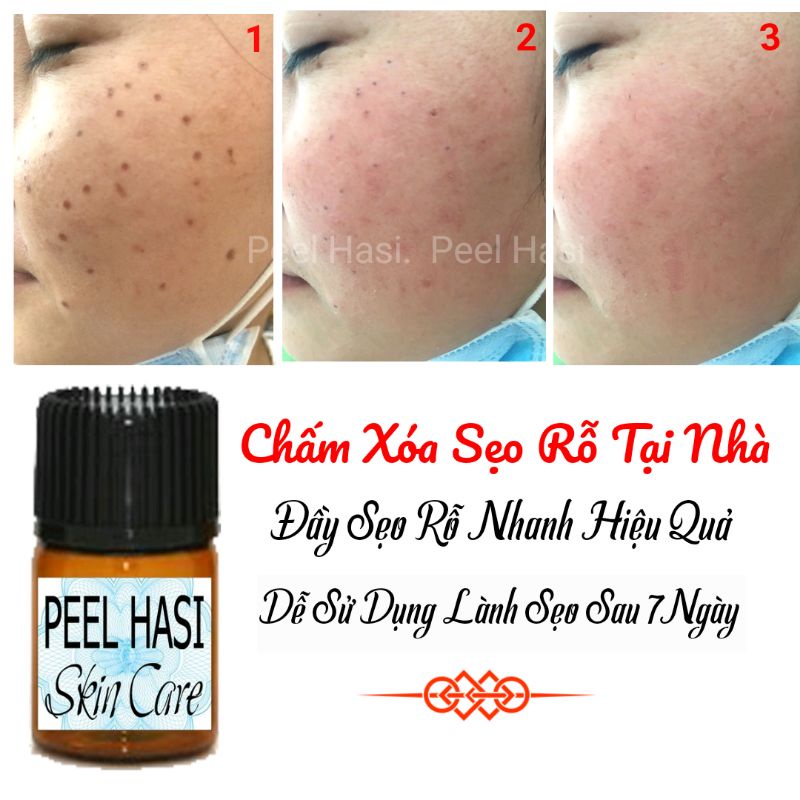 Chấm Đầy SẸO RỖ Lâu Năm. Quét Nám Tàn Nhang Peel HA SI