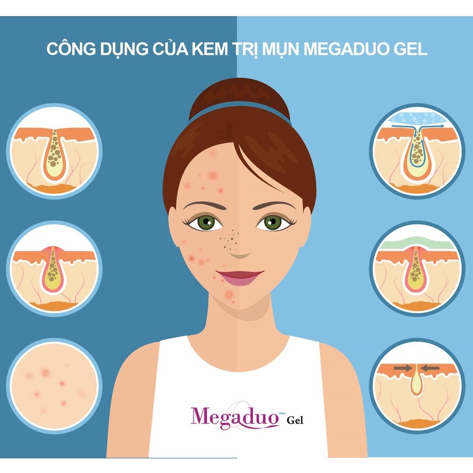 Gel Giảm Mụn Ẩn Và Thâm Gamma Megaduo Gel 15g - Bản Plus