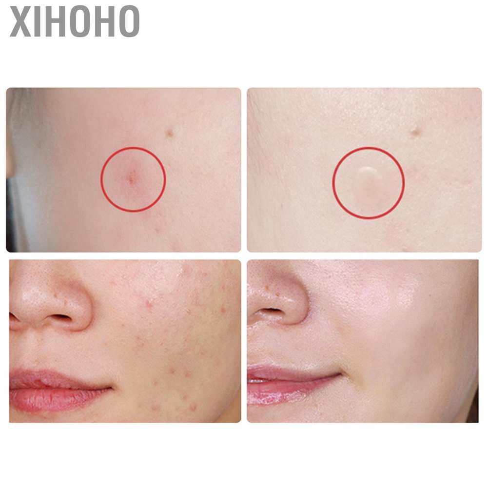 (hàng Mới Về) Miếng Dán Trị Mụn Tinh Chất Tràm Trà | BigBuy360 - bigbuy360.vn