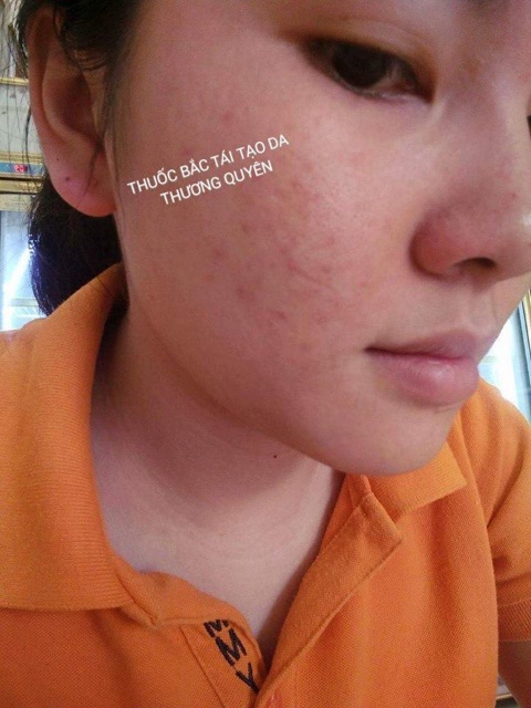 Đông y tái tạo da thương quyên size lọ dùng 2 tháng