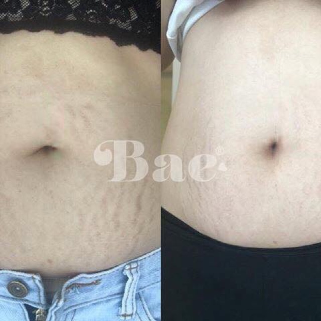 Tinh chất trị rạn da bae