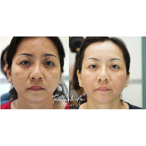 Kem Mờ Thâm Nách, Bẹn, Mông, Mụn, Quầng Mắt VERA - Công Dụng 7 Trong 1 - Tâm Sinh An Cosmetic - Mãi Mãi Tuổi 18 | BigBuy360 - bigbuy360.vn