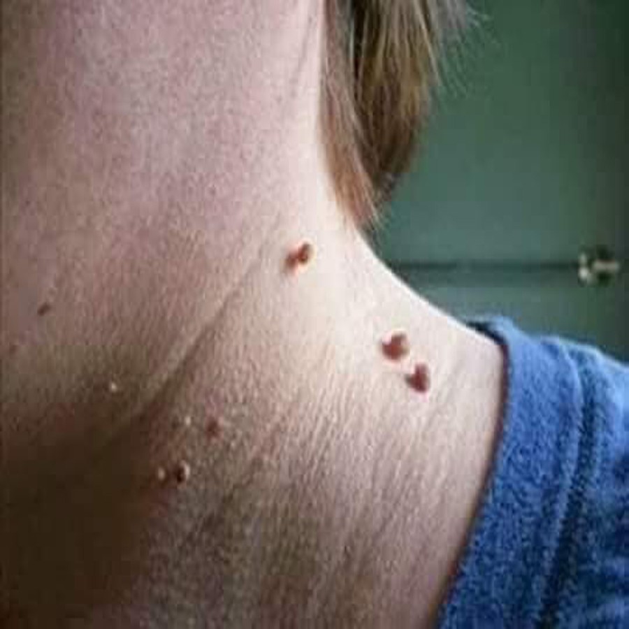 Dung dịch diệt mụn cơm, mụn cóc, sạn cá, mụn thịt của nga, sẵn hàng | BigBuy360 - bigbuy360.vn