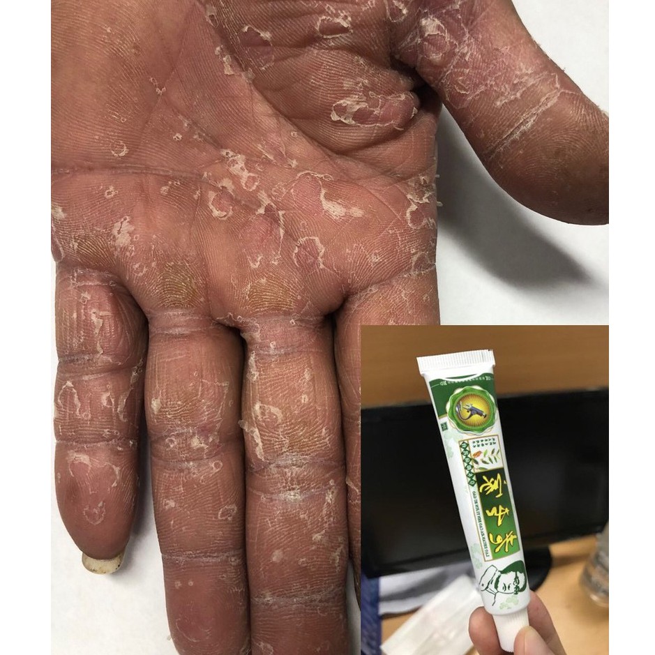 Kem Bôi Nứt Nẻ Á Sừng Tay Chân Ngoài Da - KEM BÔI ĐÔNG Y-Bong Tróc Khô Da | BigBuy360 - bigbuy360.vn