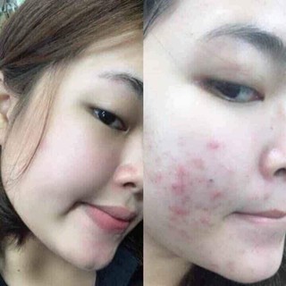 Kem trị mụn Pair Nhật Bản