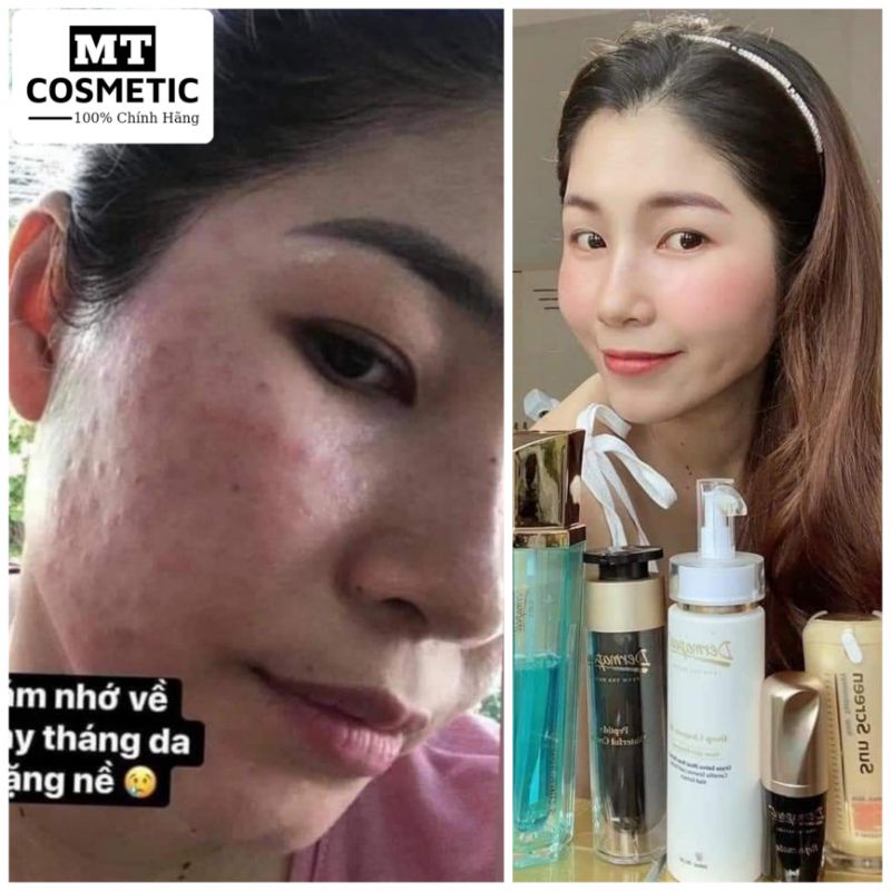 COMBO DERMAPEEL+ DƯỠNG DA TOÀN DIỆN NGÀY VÀ ĐÊM -Sạch mụn - Phục hồi da hư tổn - Da căng bóng trắng sáng - mờ thâm nám