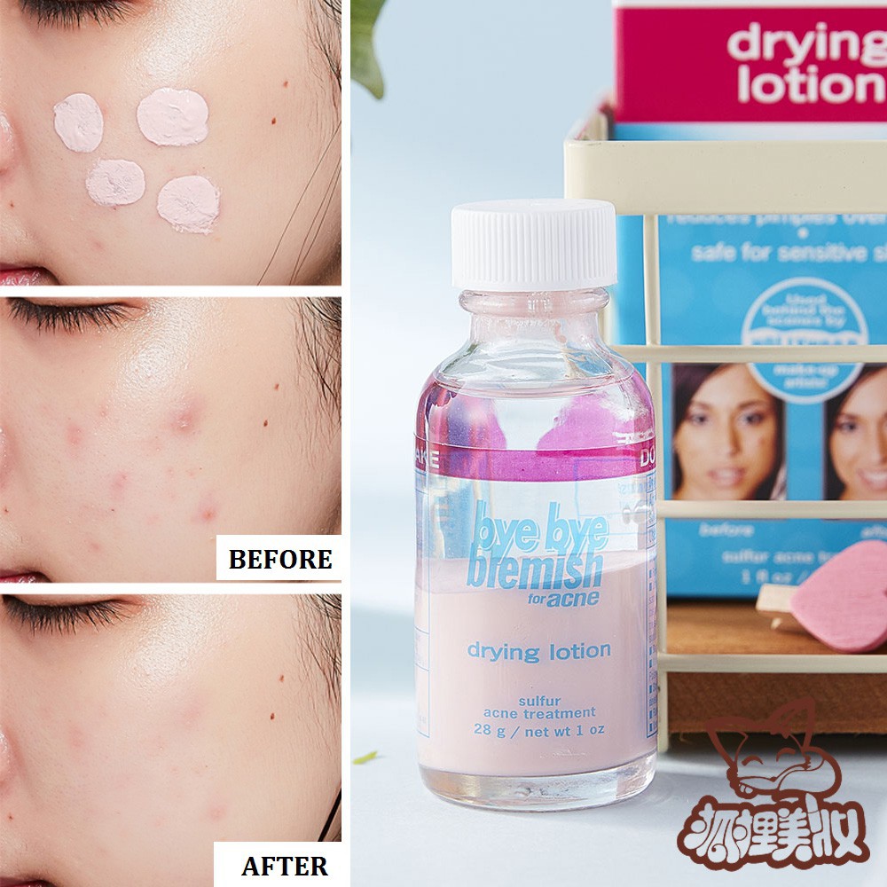 Chấm mụn Bye Bye Blemish Drying Lotion