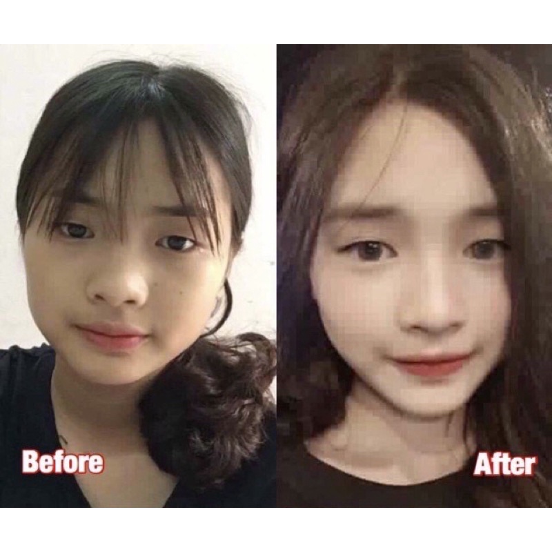 Tinh chất thu xương hàm má Miracle, hiệu quả chỉ sau 14 ngày