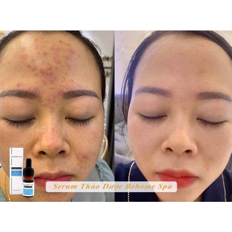 Serum mụn Thảo dược Behome Spa  👉FREESHIP👉 Serum mụn thảo Dược Behome Spa, Mụn ẩn, mụn thâm, mụn cám, mụn viêm | BigBuy360 - bigbuy360.vn