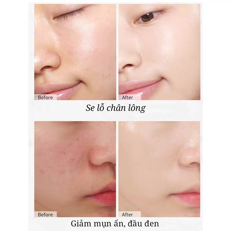 Nước hoa hồng BFACE SAMANLI  ngăn ngừa mụn ẩn se lỗ chân lông Rosemary Verbenone Hydrosol Verbena BFAC01 SAML04