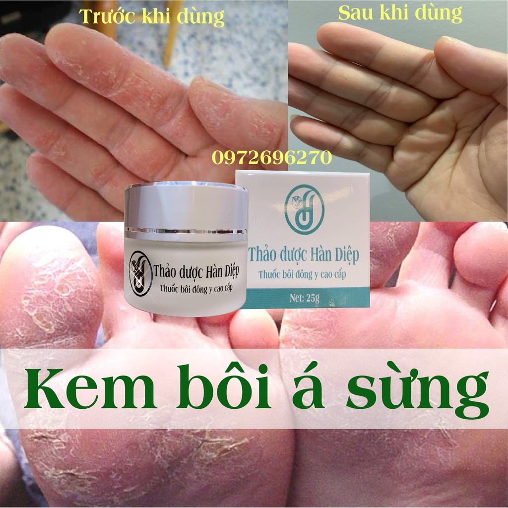 Kem bôi đặc tri Á Sừng - Hàn Diệp [ Cực hiệu quả ]