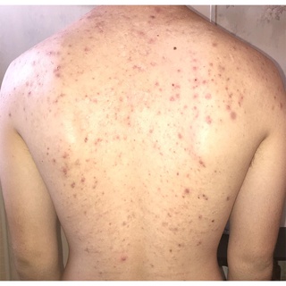 Xà Phòng Giảm Mụn Lưng For Back Medicated Soap