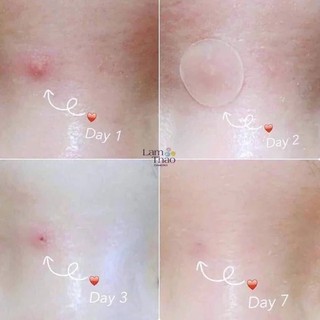Miếng Dán Mụn Cosrx Acne Pimple Master Patch