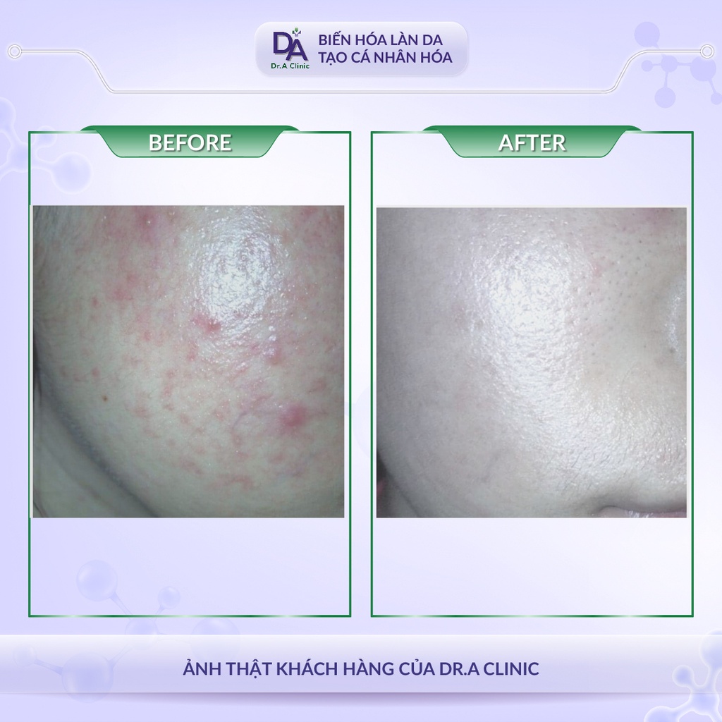 Adapalene Gel 0.1% Adaferin Chính Hãng Dr.A, trợ thủ dẹp mụn tuyệt đỉnh cho bạn nâng cấp bản thân