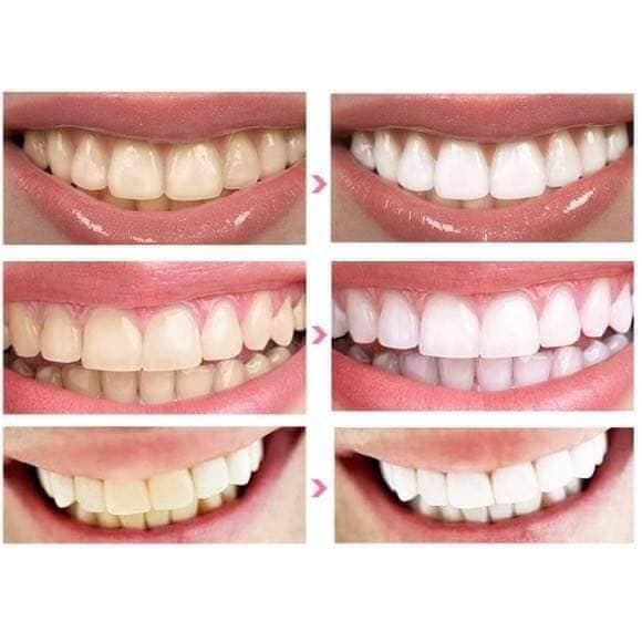 Miếng Dán Trắng Răng Tiện Lợi 3D 5D White Teeth Whitening Strips KallynBeauti