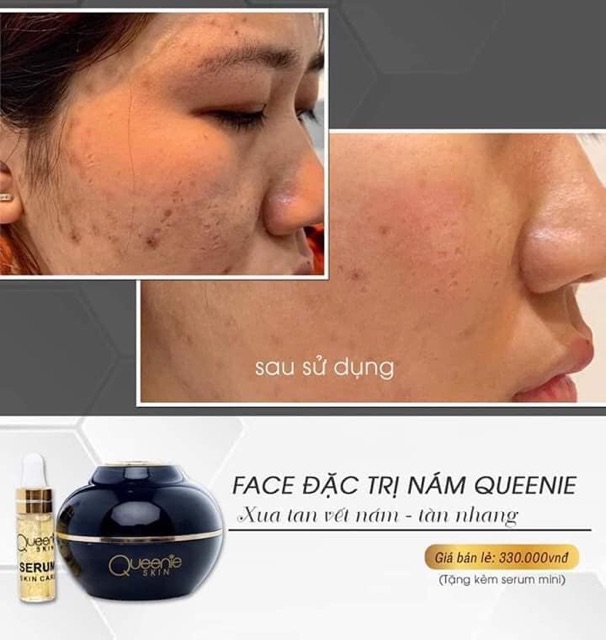 [TẶNG KÈM SERUM] KEM FACE NÁM TÀN NHANG QUEENIE SKIN | BigBuy360 - bigbuy360.vn
