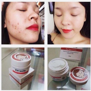 KEM GIẢM MỤN CIRACLE RED SPOT CREAM