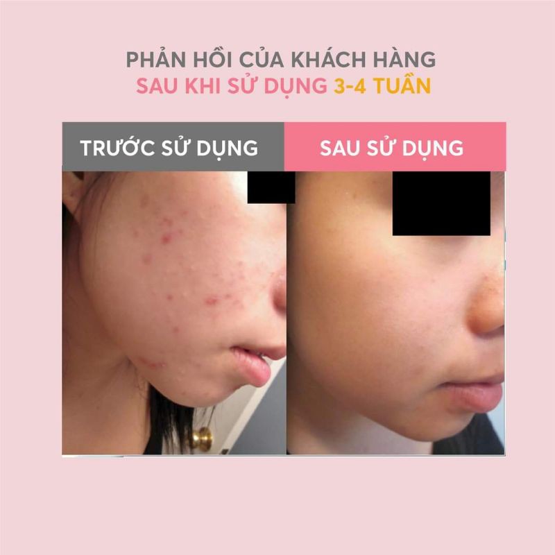 YOTEEN Gel ngăn ngừa mụn,chống viêm ,cung cấp độ ẩm cho da