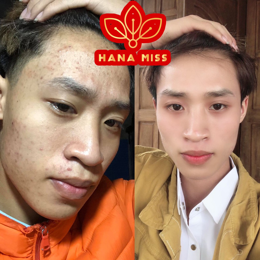 [DEAL SỐC] Serum xoá mụn giảm mụn - HANA MISS 🚫CAM KẾT KHÔNG HẾT MỤN HOÀN TIỀN🚫 | BigBuy360 - bigbuy360.vn