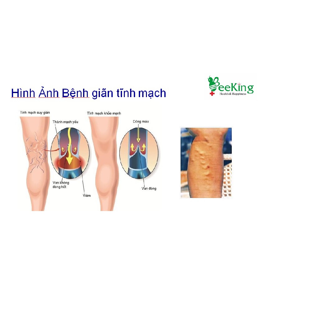 Venocontract Gel-Hết suy giãn tĩnh mạch, rối loạn tuần hoàn chi dưới, mỏi mệt Bắp chân, kiến bò dưới chân - BeeKing | BigBuy360 - bigbuy360.vn